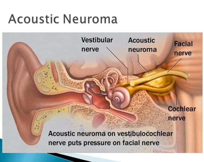 Θεραπεία Ακουστικού Νεύρου
