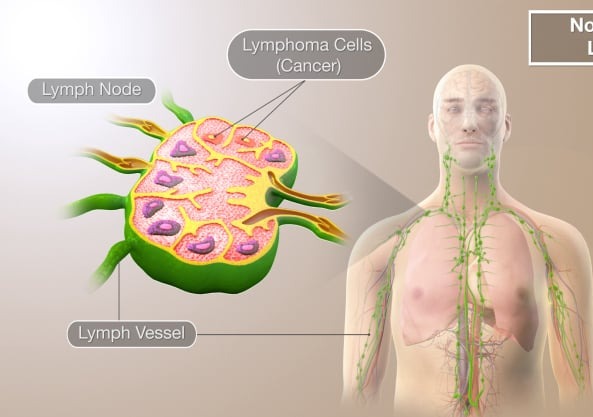Νευρολογικές εκδηλώσεις
