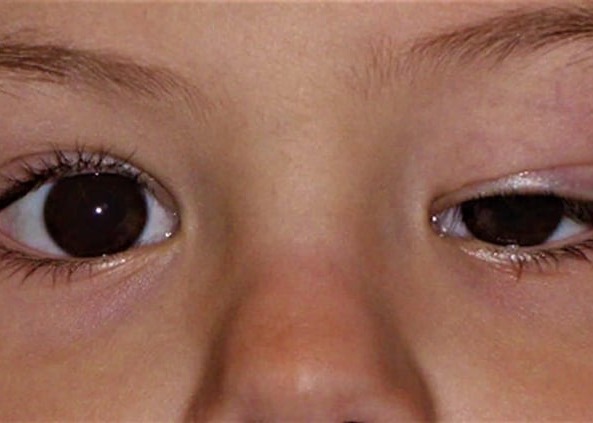 Μυασθένεια – μυοπάθειες