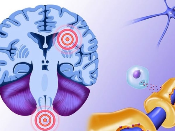 Πολλαπλή σκλήρυνση